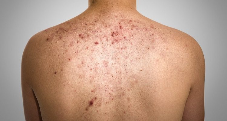 PREVENIR E TRATAR BORBULHAS NAS COSTAS